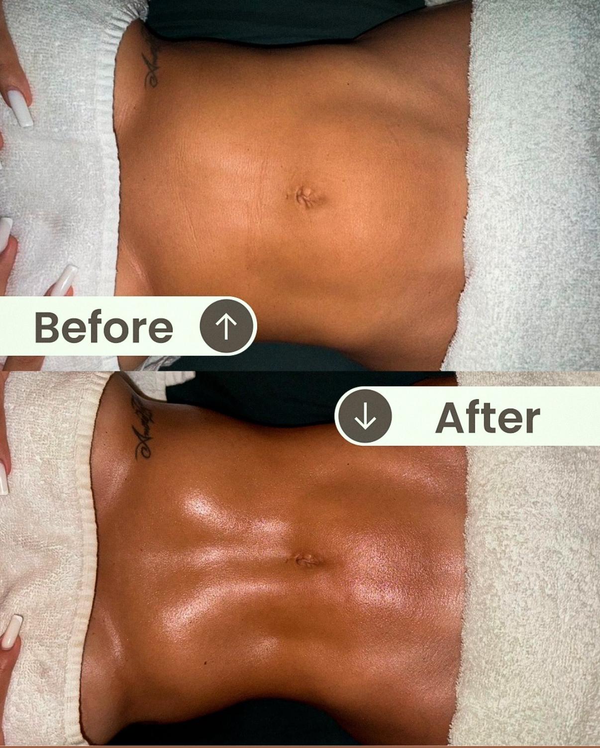 Abdomen antes y después en una comparativa vertical