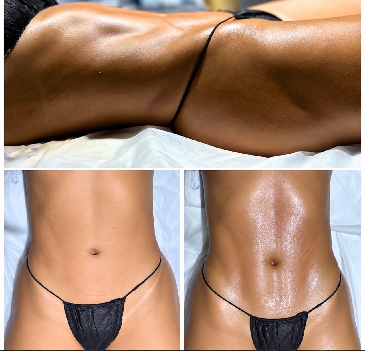 Comparativa de abdomen y vista lateral de un tratamiento corporal