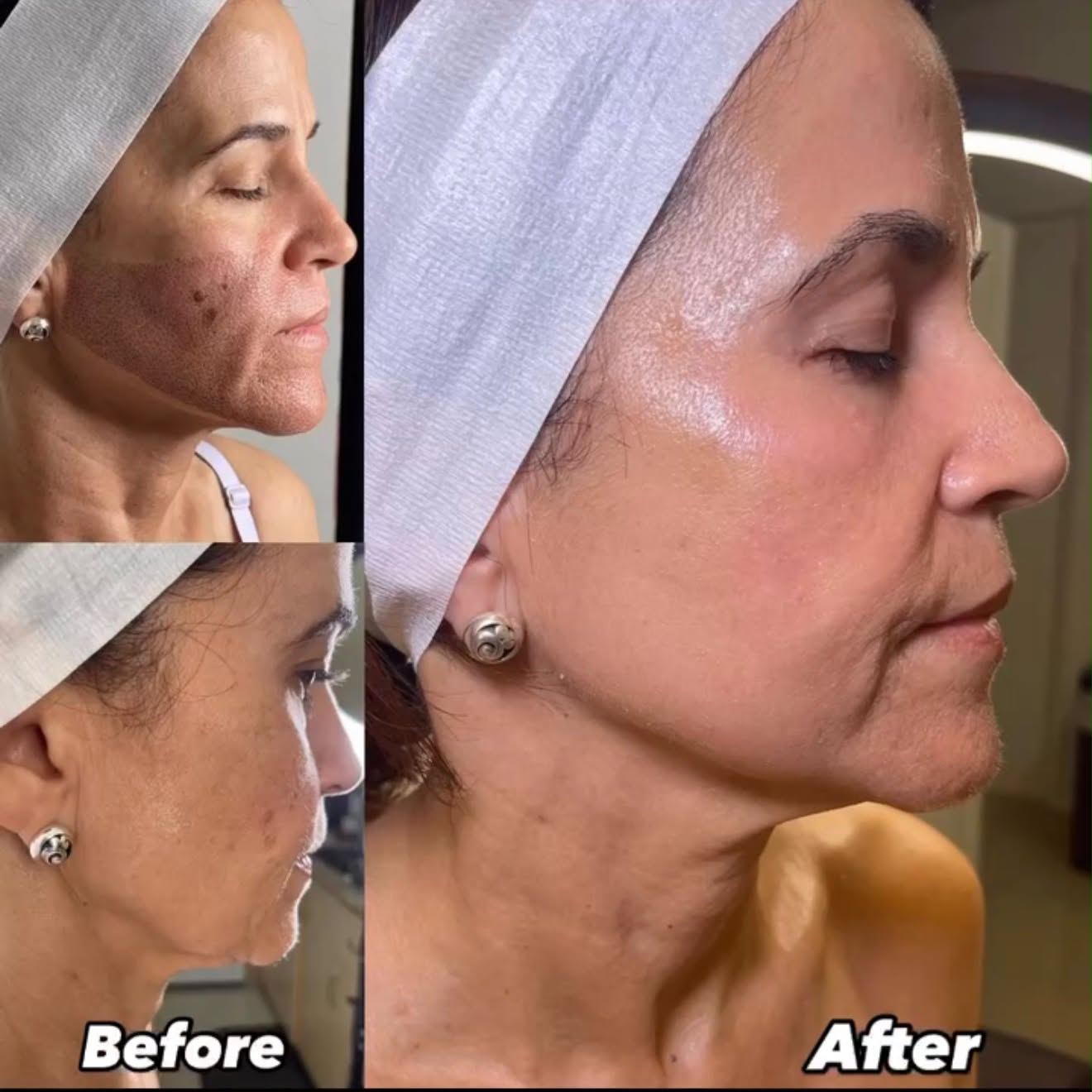 Comparativa de la piel del rostro antes y después de un tratamiento facial